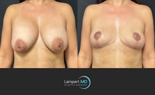 Breast Explant Before & After Gallery - Patient 283942 - Image 1