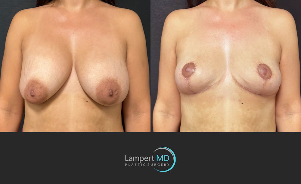 Breast Explant Before & After Gallery - Patient 283942 - Image 2
