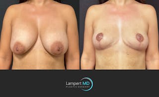 Breast Explant Before & After Gallery - Patient 283942 - Image 2