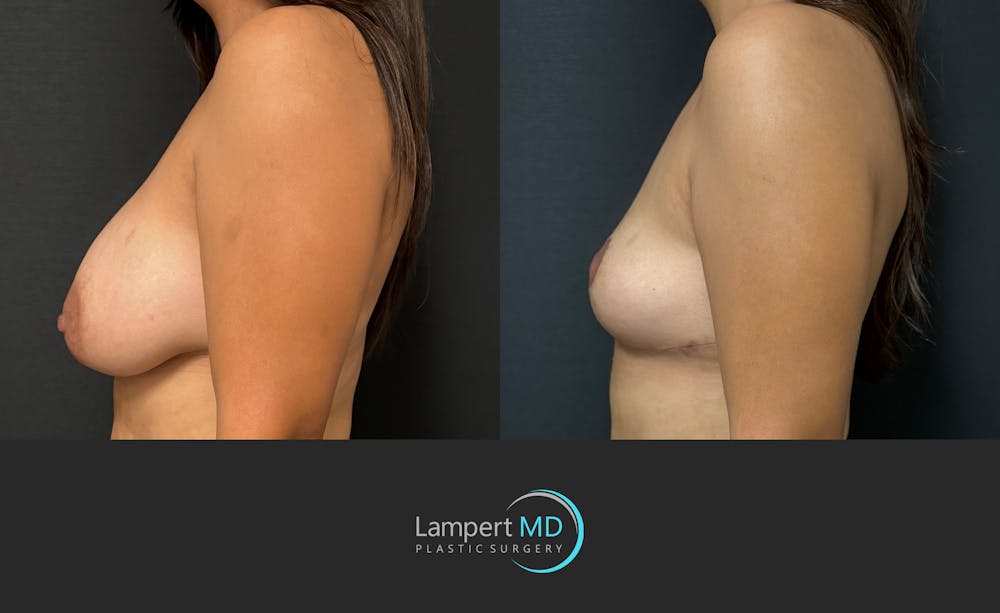 Breast Explant Before & After Gallery - Patient 283942 - Image 5
