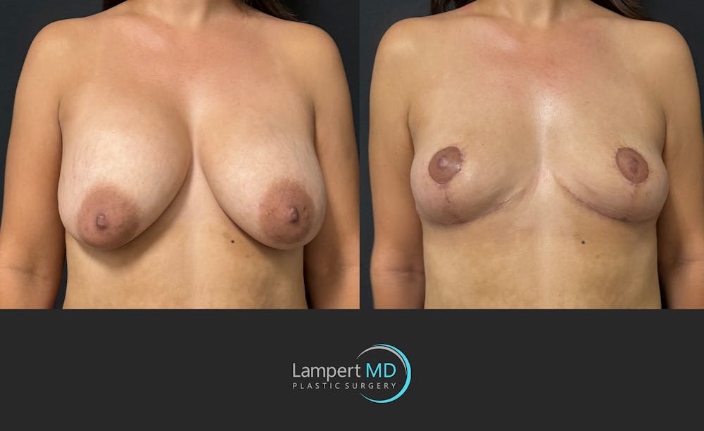 Breast Explant Before & After Gallery - Patient 283942 - Image 3