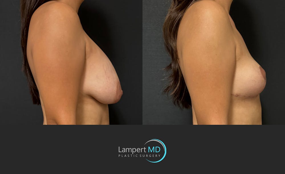 Breast Explant Before & After Gallery - Patient 283942 - Image 4