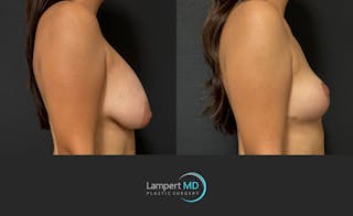 Breast Explant Before & After Gallery - Patient 283942 - Image 4