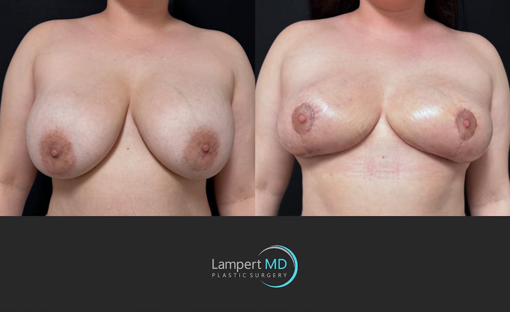 Breast Explant Before & After Gallery - Patient 242696 - Image 1