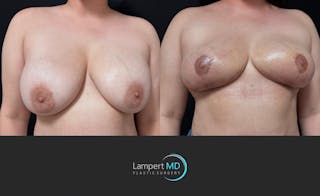 Breast Explant Before & After Gallery - Patient 242696 - Image 4