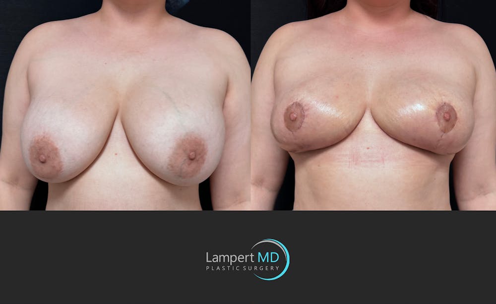Breast Explant Before & After Gallery - Patient 242696 - Image 3