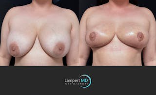Breast Explant Before & After Gallery - Patient 242696 - Image 3