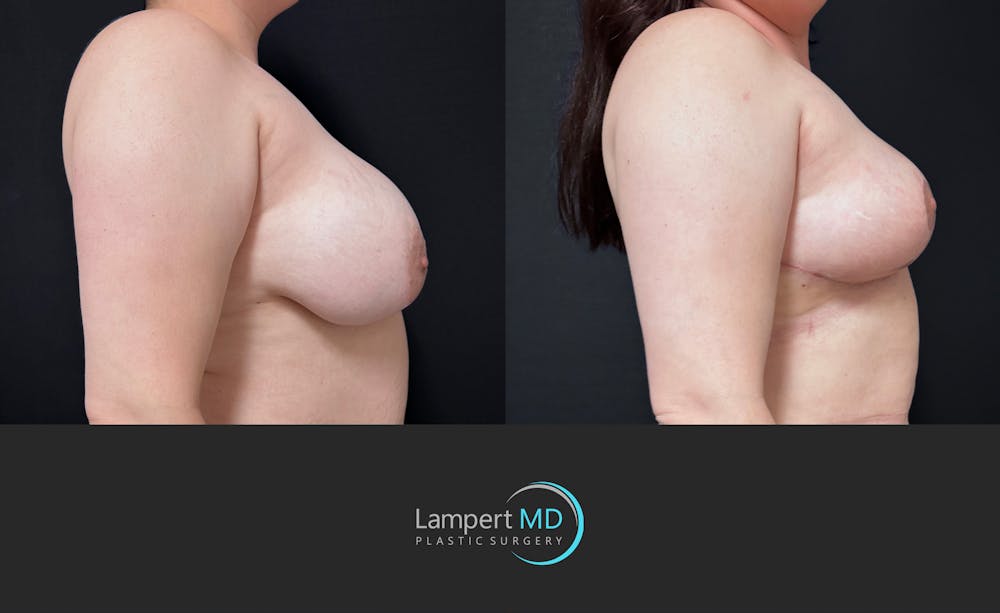 Breast Explant Before & After Gallery - Patient 242696 - Image 5