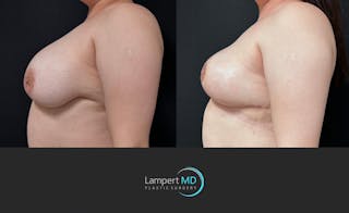 Breast Explant Before & After Gallery - Patient 242696 - Image 2