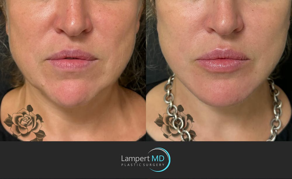 Face & Neck Lift Before & After Gallery - Patient 493251 - Image 1