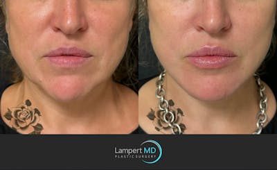 Face & Neck Lift Before & After Gallery - Patient 493251 - Image 1