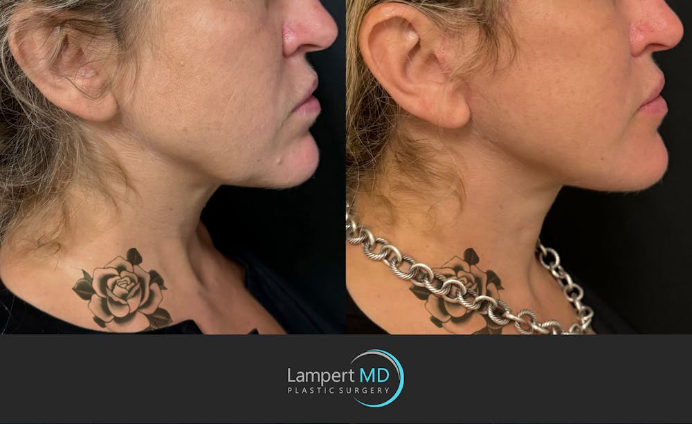 Face & Neck Lift Before & After Gallery - Patient 493251 - Image 3