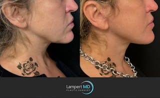 Face & Neck Lift Before & After Gallery - Patient 493251 - Image 3