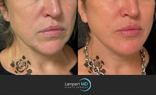 Face & Neck Lift Before & After Gallery - Patient 493251 - Image 2
