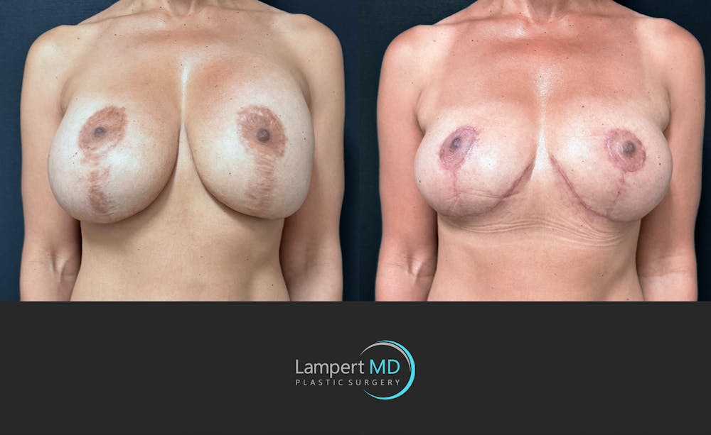 Breast Explant Before & After Gallery - Patient 171630 - Image 3