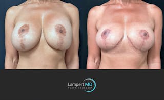 Breast Explant Before & After Gallery - Patient 171630 - Image 3