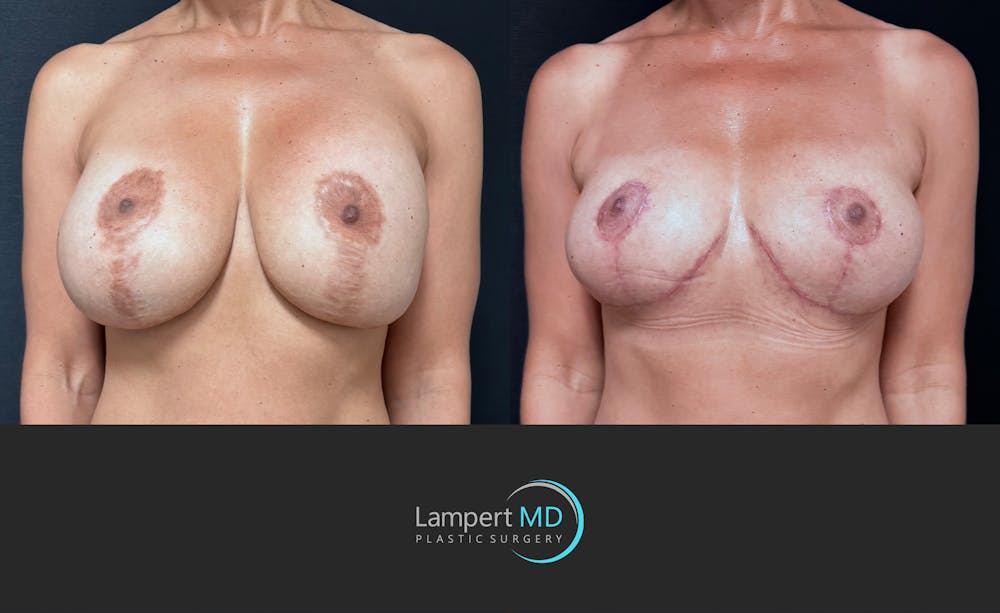 Breast Explant Before & After Gallery - Patient 171630 - Image 1