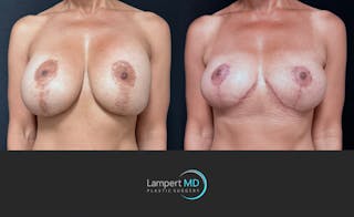 Breast Explant Before & After Gallery - Patient 171630 - Image 1