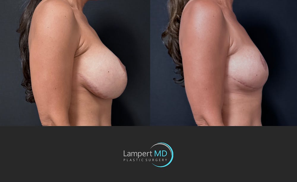 Breast Explant Before & After Gallery - Patient 171630 - Image 4