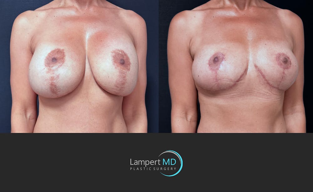 Breast Explant Before & After Gallery - Patient 171630 - Image 2