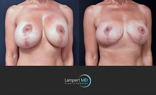 Breast Explant Before & After Gallery - Patient 171630 - Image 2