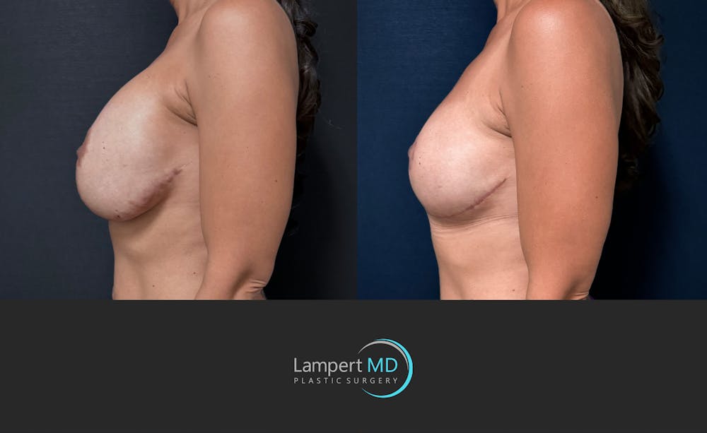 Breast Explant Before & After Gallery - Patient 171630 - Image 5
