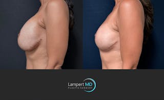 Breast Explant Before & After Gallery - Patient 171630 - Image 5