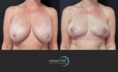 Breast Explant Before & After Gallery - Patient 167179 - Image 1