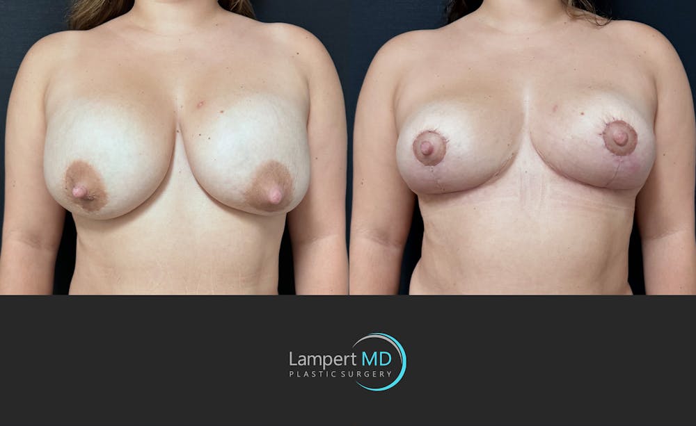 Breast Explant Before & After Gallery - Patient 143027 - Image 1