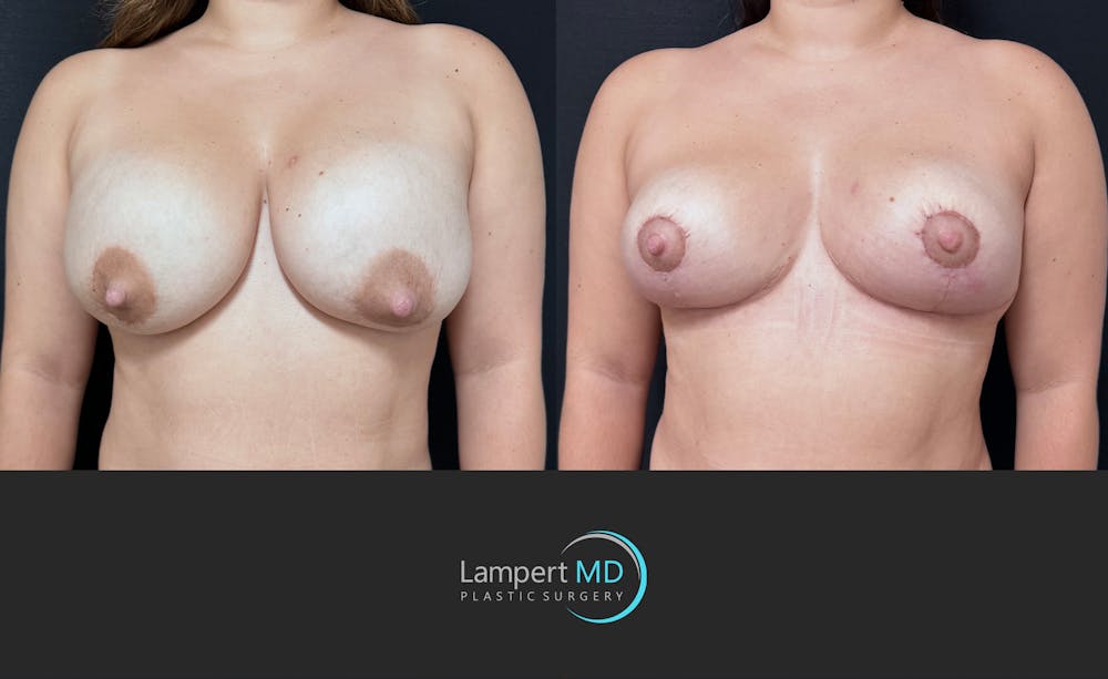 Breast Explant Before & After Gallery - Patient 143027 - Image 3
