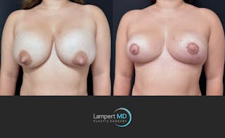 Breast Explant Before & After Gallery - Patient 143027 - Image 3