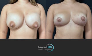 Breast Explant Before & After Gallery - Patient 143027 - Image 2