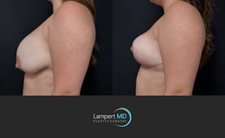 Breast Explant Before & After Gallery - Patient 143027 - Image 5