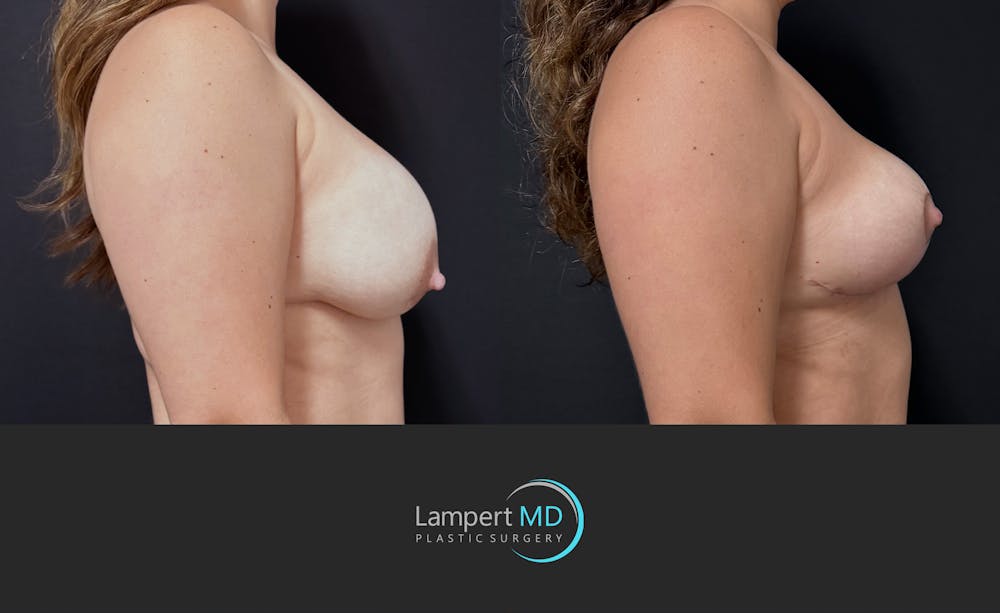 Breast Explant Before & After Gallery - Patient 143027 - Image 4