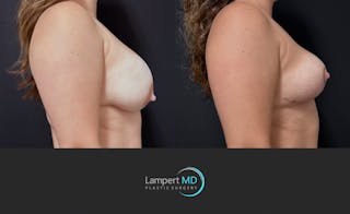 Breast Explant Before & After Gallery - Patient 143027 - Image 4