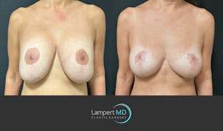 Breast Explant Before & After Gallery - Patient 109890 - Image 1