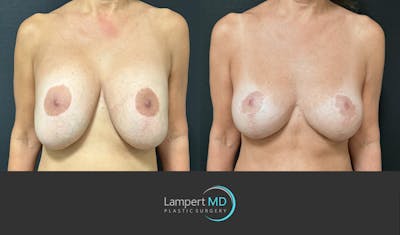 Breast Explant Before & After Gallery - Patient 109890 - Image 1