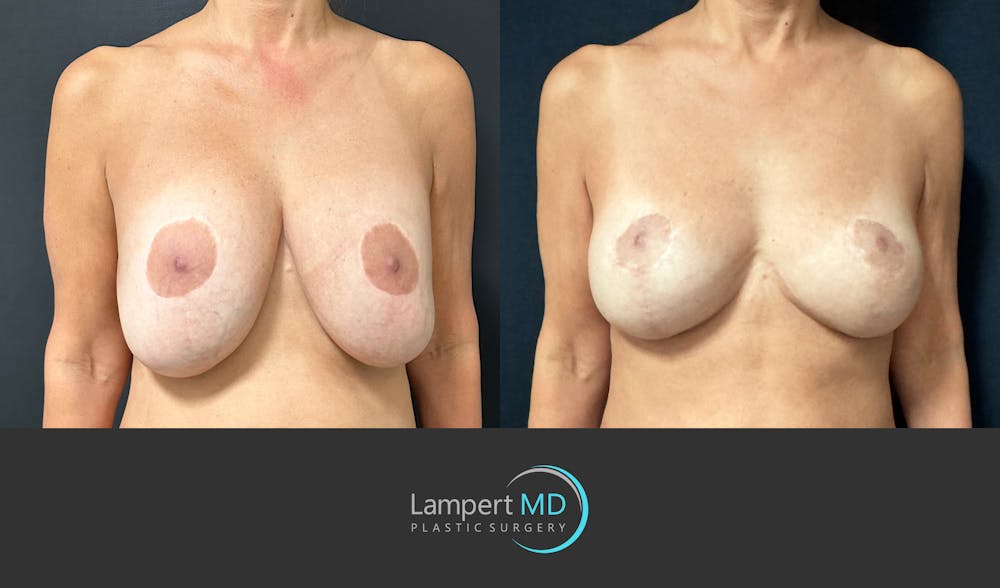 Breast Explant Before & After Gallery - Patient 109890 - Image 2
