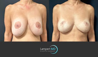 Breast Explant Before & After Gallery - Patient 109890 - Image 2