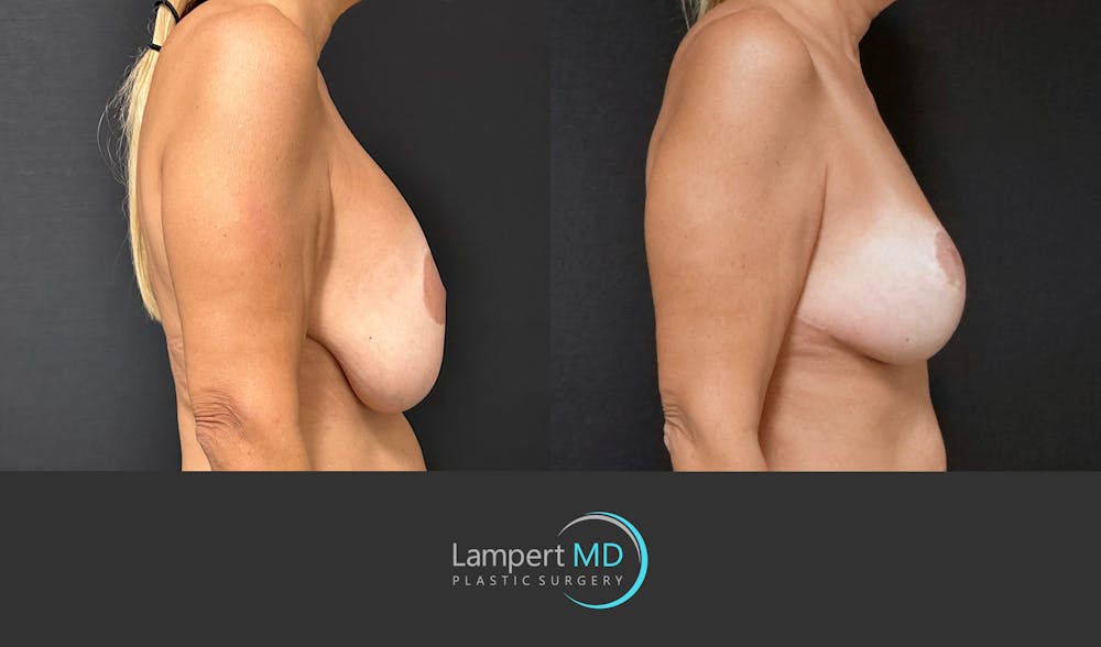 Breast Explant Before & After Gallery - Patient 109890 - Image 4