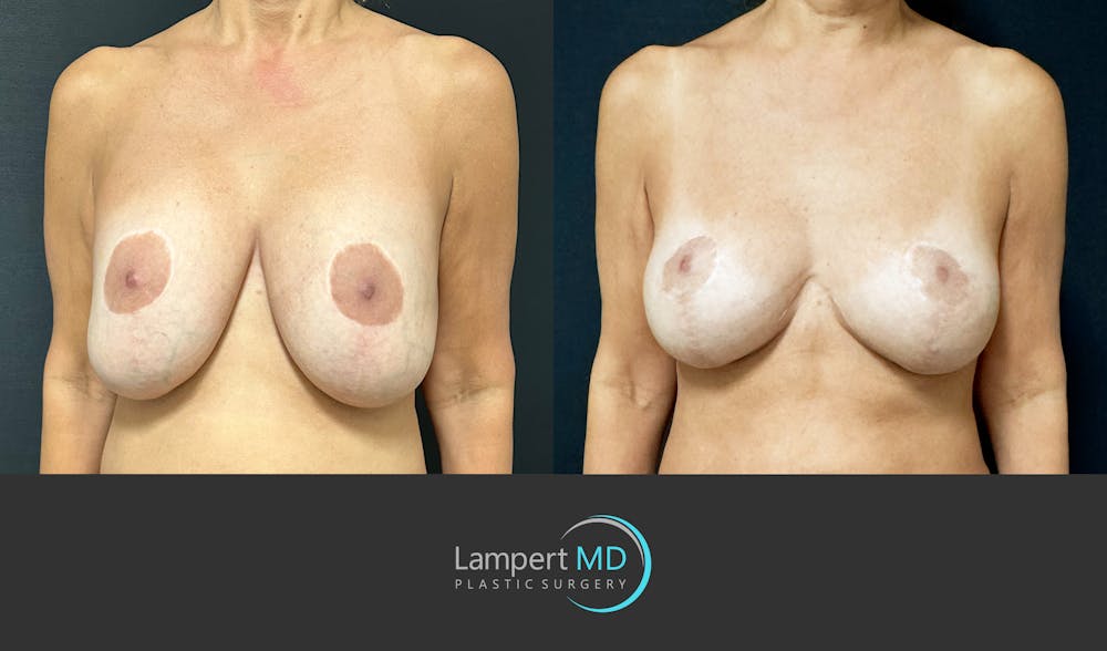 Breast Explant Before & After Gallery - Patient 109890 - Image 3
