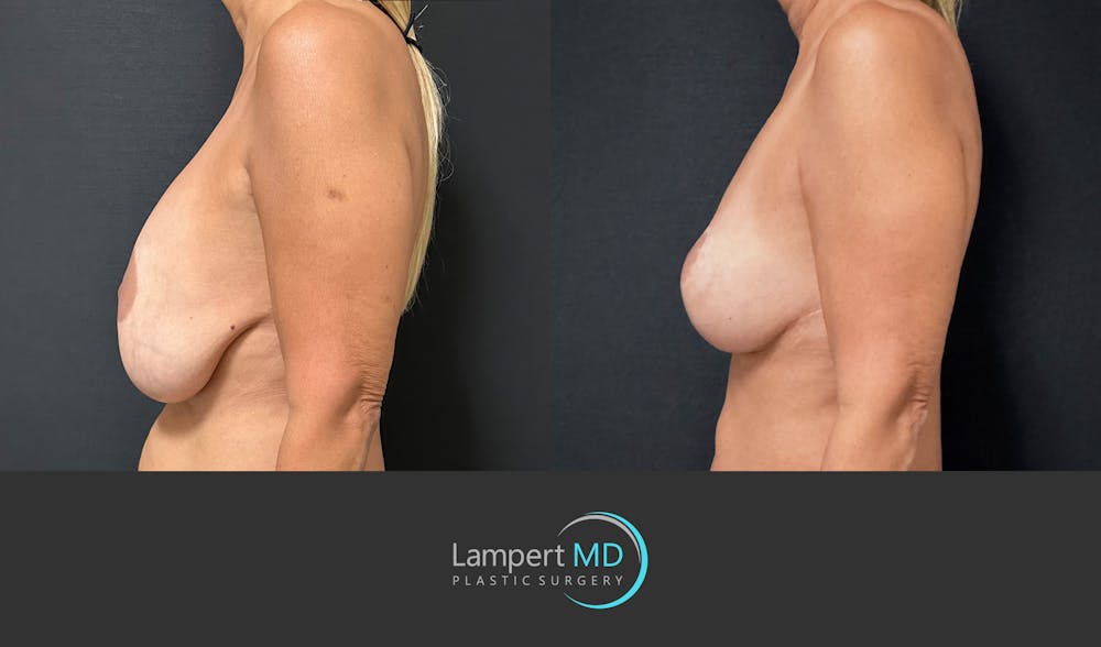 Breast Explant Before & After Gallery - Patient 109890 - Image 5