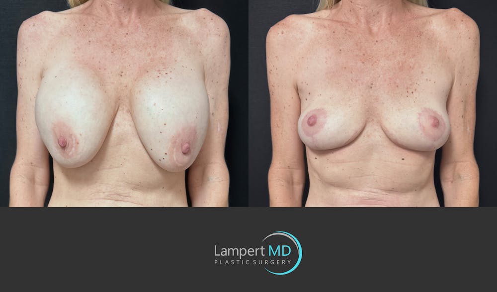 Breast Explant Before & After Gallery - Patient 262466 - Image 1