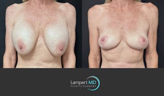 Breast Explant Before & After Gallery - Patient 262466 - Image 1