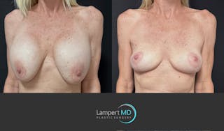 Breast Explant Before & After Gallery - Patient 262466 - Image 3