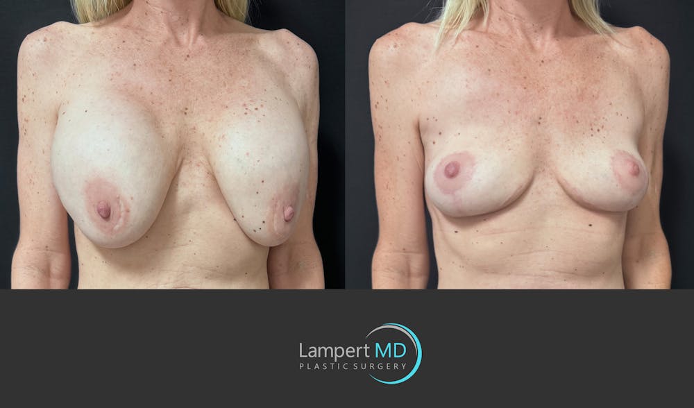 Breast Explant Before & After Gallery - Patient 262466 - Image 2