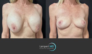 Breast Explant Before & After Gallery - Patient 262466 - Image 2