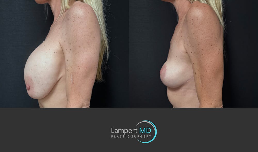 Breast Explant Before & After Gallery - Patient 262466 - Image 5