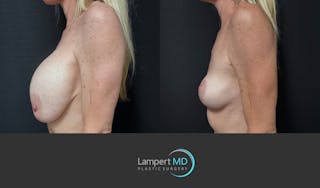 Breast Explant Before & After Gallery - Patient 262466 - Image 5