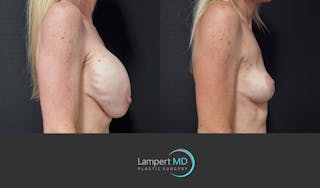 Breast Explant Before & After Gallery - Patient 262466 - Image 4